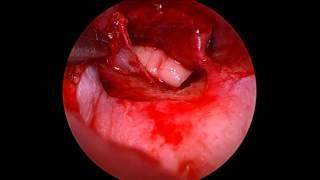 Endoscopic Cartilage and Ossicular Reconstruction_Dr Nirmal Patel