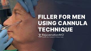 Full Face Rejuvenation with Filler for Men