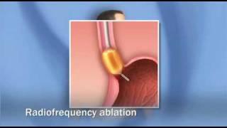 Treatments for Barrett's Esophagus, Dysplasia, Esophagus Cancer (adenocarcinoma) - Mayo Clinic