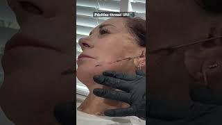 PDO Thread Lift Procedure | Instant Non-Surgical Facelift at ONE AESTHETICS Medspa #pdothreads