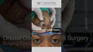 Cosmetic orbital decompression for repair bugling eye