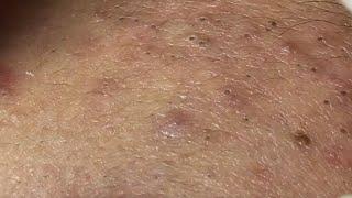 New Blackheads & Cystic Removal For Boy 2024| Acne Perennial On Cheek