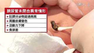 臍尿管閉合不全 囊腫破裂 尿液從肚臍噴出