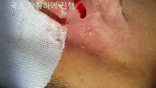 피지낭종 , 표피낭종 steatocystoma  not infected