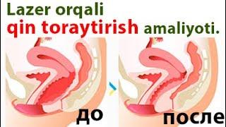 Lazer orqali qin toraytirish amaliyoti.