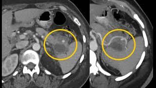 CT Evaluation of the Spleen: Challenges in Diagnosis Part 3