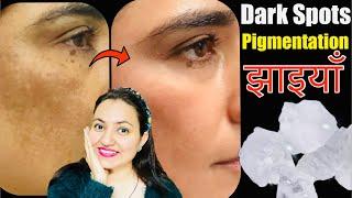 फिटकरी (Alum) से मुश्किल झाइयाँ Hyperpigmentation Melasma काले धब्बे Dark Spots का करें 100% इलाज