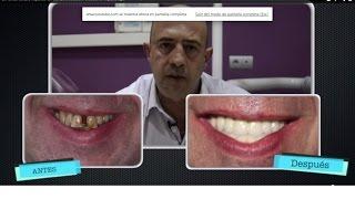 Dr. Ismael Soriano  Implantes con dientes inmediatos  Formación en Implantología