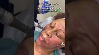 Micro-Needling