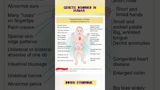 Down Syndrome | Trisomy 21 | Genetic Disorder in Human