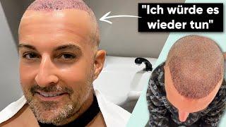 10 Tage nach der Haartransplantation im Memorial | Marcels Erfahrung