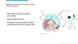 Peritoneal Mesothelioma Treatment | 2022 International Symposium on Malignant Mesothelioma