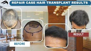 Hair Transplant In Chennai | Best Surgeon Cost Hospital & Results Of Hair Transplant Of Chennai