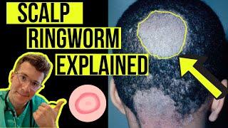 Doctor explains Scalp Ringworm (Tinea Capitis) including causes, symptoms, treatment & more!