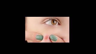 natural remedies for pimples and acne