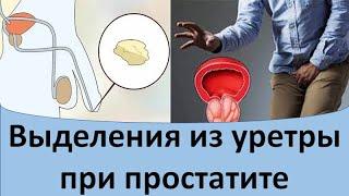 Выделения из уретры при простатите