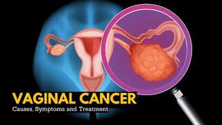 Vaginal cancer, Causes, Signs and Symptoms, DIagnosis and Treatment.