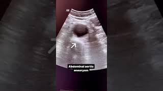 aortic aneurysm#imaging #ultrasound #medicine #medicalimaging