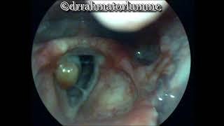 Pyogenic Granuloma of Larynx