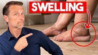 #1 Vitamin to Eliminate Swollen Legs and Ankles