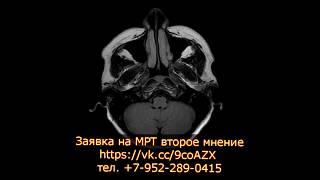 Микроаденома гипофиза параселлярно справа на МРТ второе мнение выполненной проф. Холиным А.В.