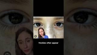 Freckles vs Age Spots #dermatologist @DrDrayzday