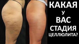 Какая у Вас Стадия Целлюлита И Можно ли Вас Спасти