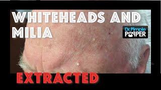 Whiteheads and milia extracted after Mohs surgery