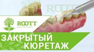 Чистка пародонтальных карманов. Закрытый кюретаж. Клиника ROOTT