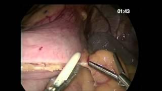 Laparoscopic Sleeve Gastrectomy with Caiman 5