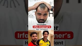 Youtuber Irfan Dreamer Hair Transplant Surgery  #shorts #viral #hairtransplant