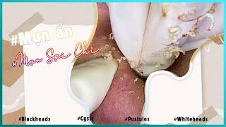 Big Cystic Acne Blackheads Extraction Blackheads & Milia, Whiteheads Removal Pimple Popping