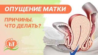 ⭕ Опущение матки. Причины. Чем грозит опущение или выпадение матки и что делать?