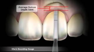 Chu's Sounding Gauge