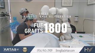 Hair By Dr. Max, Restoration Center - 1800 FUE Grafts ARTAS® Robotic Hair Restoration