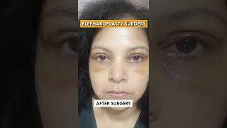 Get rid of puffy eyes today - Blepharoplasty surgery in Delhi! #blepharoplasty #puffyeyes #eyebags