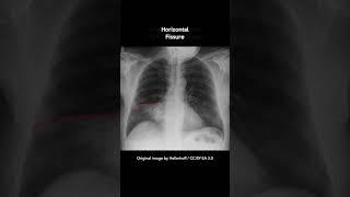 Right Middle Lobe Pneumonia Chest X-ray #shorts