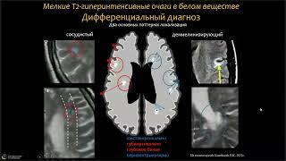 Вебинар МРО РОРР: "Дифференциальная МРТ диагностика при рассеянном склерозе"