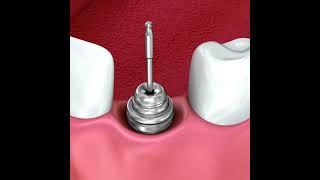 Dental Implant Procedure Explained Step by StepDental implant placement is a surgical procedure  #fu