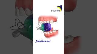Functional Appliance #dentist #functional  #orthodontics #dental # dentalesthetics #dentaltreatment