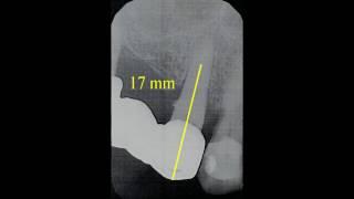 Zalomený nástroj v kořeni zubu.  Vyjmutí pod mikroskopem Zeiss. DentaMedika.cz