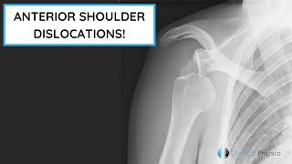 Anterior Shoulder Dislocations | Assessment & Management