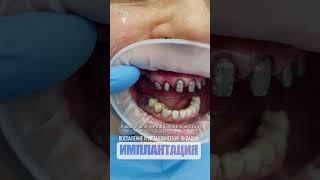 Воспаление и металлические вкладки. Inflammation and metal tabs. #dentist