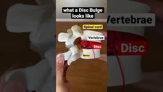 what a Disc Bulge looks like 