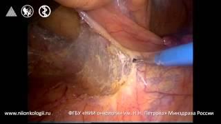 Laparoscopic AR for Rectosigmoid Tumor сT4аN0M0