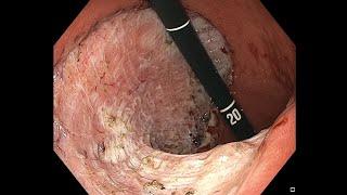 Gastric ESD