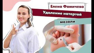 Удаление натертой мозоли