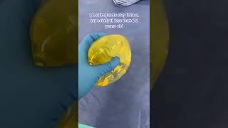 Why Are These 18 Year Old Breast Implants Slightly Yellow? #shorts #breastimplants