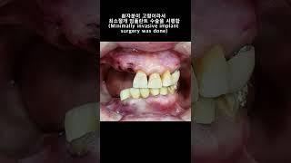 앞니 임플란트 지르코니아, 교합 거상 환자(Anterior implant zirconia, Bite raising)