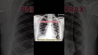 Normal and abnormal chest #shortvideo #x ray